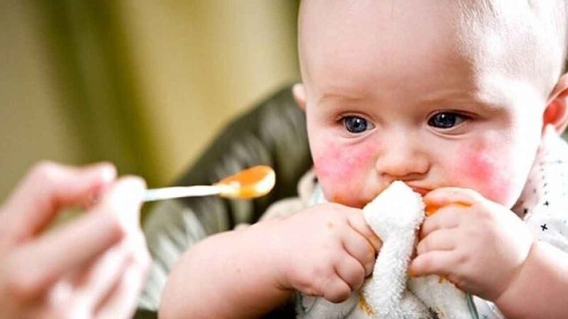 Uşaqlarda qida allergiyası